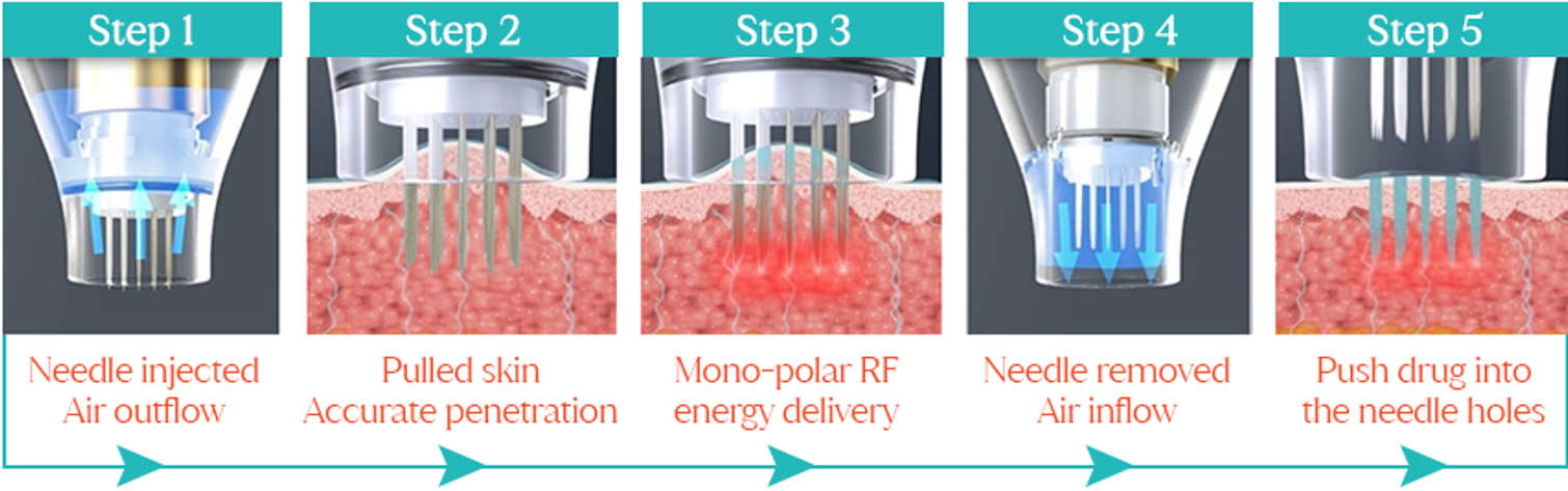 5 Steps of Potenza Microneedling